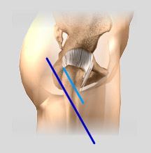Minimally Invasive Hip Replacement Chula Vista, San Diego
