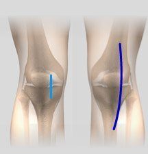Minimally Invasive Knee Replacement Chula Vista, San Diego