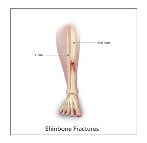 Shinbone Fractures